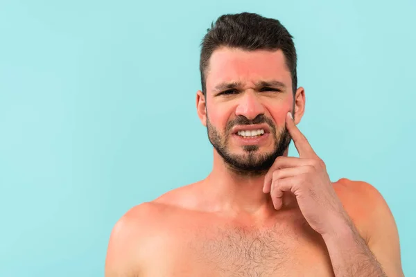 Joven hombre sin camisa con quemaduras solares mirando a la cámara aislada en azul - foto de stock