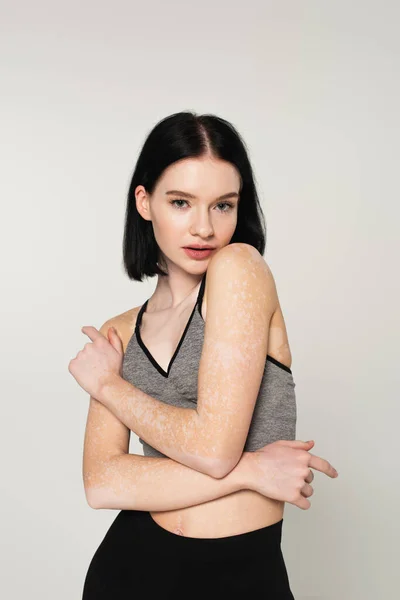 Young sportswoman with vitiligo posing isolated on grey — Stock Photo