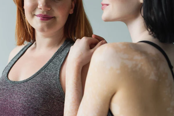 Vue recadrée d'une sportive avec accolade au vitiligo et d'un ami de taille isolé sur gris — Photo de stock