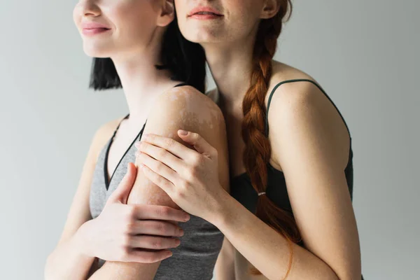 Cropped view of sportswoman embracing friend with vitiligo isolated on grey — Stock Photo