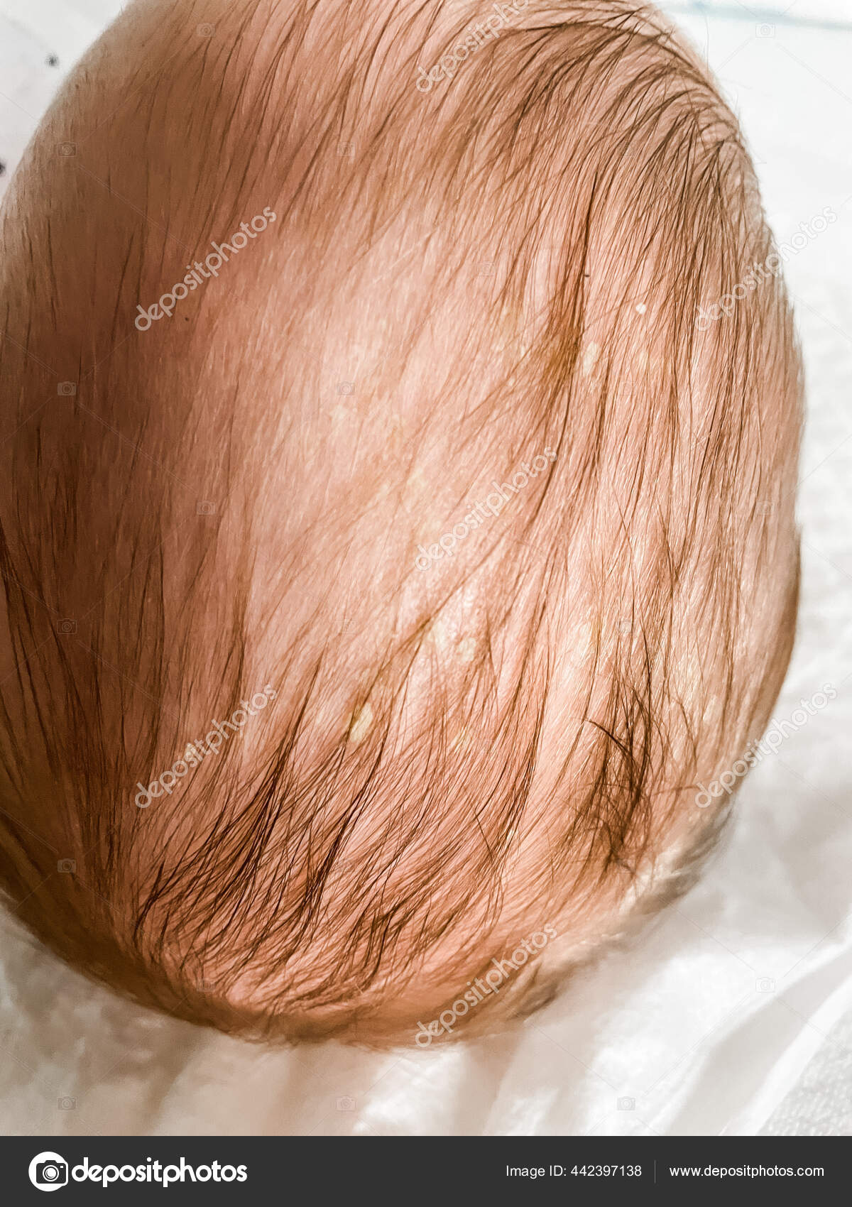 Cradle Cap Baby Boy Head Common Skin Condition Babies Stock Photo by