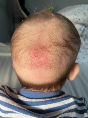 Cradle cap is a harmless skin condition that's common in babies. clipart