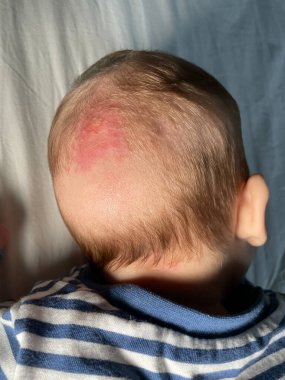 Cradle cap is a harmless skin condition that's common in babies. clipart