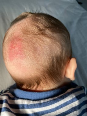 Cradle cap is a harmless skin condition that's common in babies. clipart