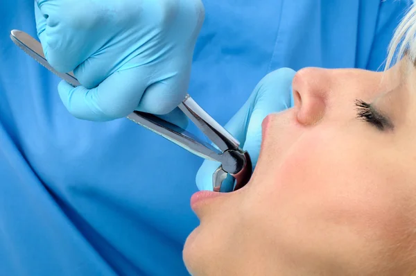 Tooth extraction — Stock Photo, Image