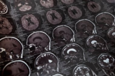 Beynin röntgen fotoğrafı. Bulanık. Çeşitli projeksiyonlarda manyetik rezonans görüntüleme.