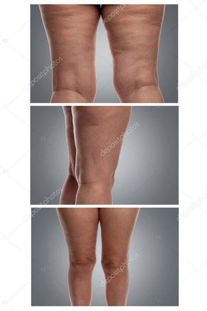 Problematic female legs with excess weight, cellulite and veins. Gray background. Collage. Vertical.