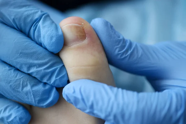 Doktorlar lastik eldivenlerle klinikte yaralı ayak tırnağına dokunuyor. — Stok fotoğraf