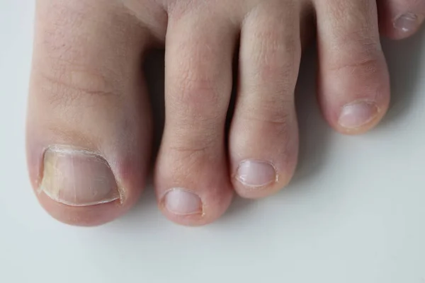 Micosis mancha amarilla en el dedo gordo del pie primer plano —  Fotos de Stock