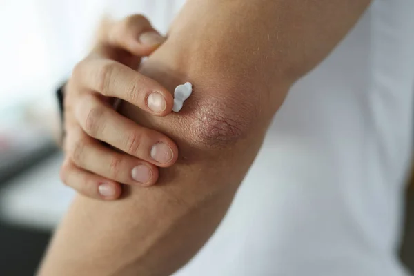 Hombre aplicando crema protectora a la piel dañada del codo de cerca —  Fotos de Stock