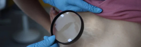 Médico en guantes de goma examinando las estrías en la piel de los pacientes espalda. Dermatólogo sosteniendo lupa en las manos — Foto de Stock