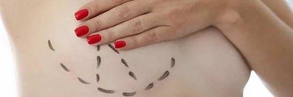 Medico ha disegnato marcatori intorno al seno in preparazione per la mammoplastica con marcatore chirurgico — Foto Stock