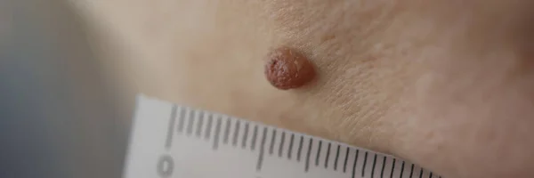 Läkaren mäter storleken på patienter pigmenterad nevus med linjal i kliniken närbild — Stockfoto