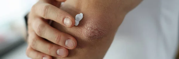 Άνδρας που εφαρμόζει προστατευτική κρέμα σε ταλαιπωρημένο δέρμα του αγκώνα close-up — Φωτογραφία Αρχείου