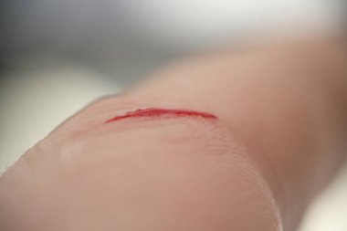 Deride kanla yakın plan kesilmiş.