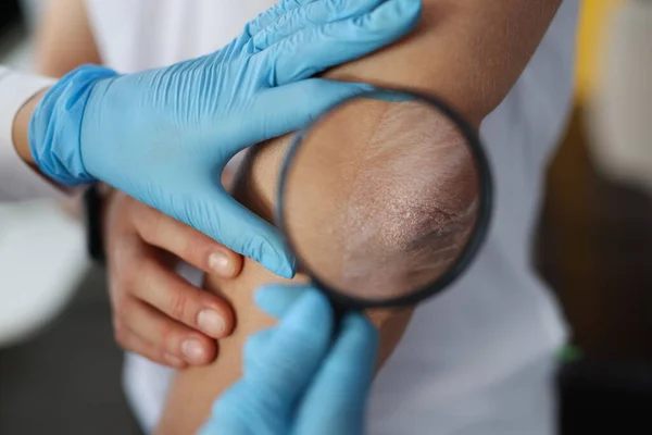 Médico examina paciente cotovelo escamoso através de lupa — Fotografia de Stock