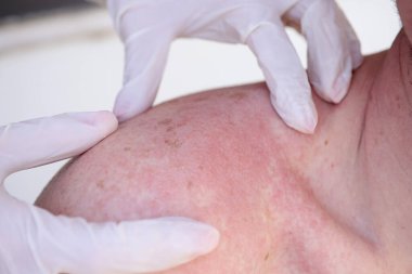 Eldivenli doktor güneş yanığı olan bir adamın ilk incelemesini yapıyor.