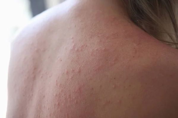 Vrouw gewond terug met uitslag en rode zonnevlekken — Stockfoto