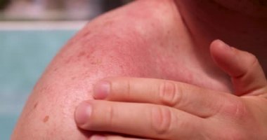 Elinde 4K filmiyle kızarık deri döküntüleri olan bir adam.