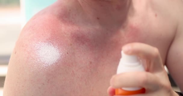 Man applying moisturizing cream to red irritated skin closeup 4k movie — Stock Video