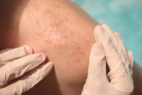 Doctor in rubber gloves examining skin of patient with red rash in clinic closeup — Stock Photo, Image