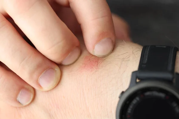 Man scratches red spot on wrist closeup — Stock Photo, Image