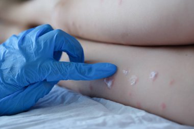 Kauçuk eldivenli doktor, çocuğun kırmızı kızarıklığına krem sürüyor.