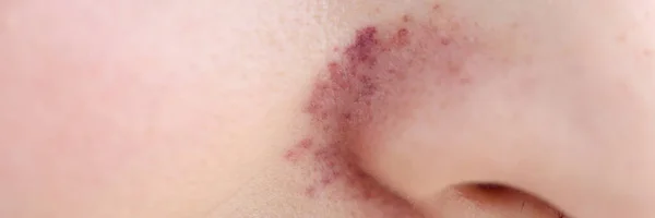 Rash on skin near woman nose closeup — Stock Photo, Image