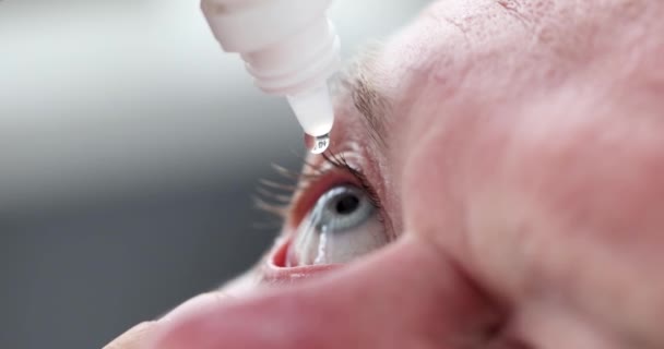 Mann tropft Augentropfen in Augen 4k Film — Stockvideo