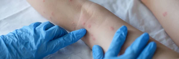 Dokter dermatoloog in rubber handschoenen onderzoeken huiduitslag op de huid van kind voeten closeup — Stockfoto