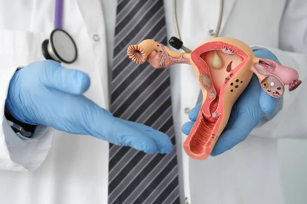 Lekarz w gumowych rękawiczkach z plastikową makietą kobiecej macicy w klinice zbliżenie — Zdjęcie stockowe