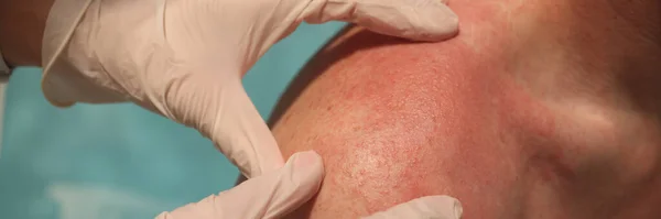 Doctor dermatologist examining rash on skin of man shoulders using gloves closeup — Stock Photo, Image
