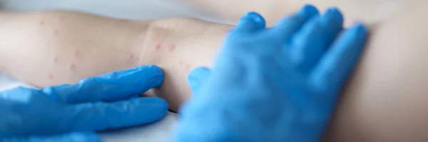 Arts onderzoekt rode huiduitslag op benen van het kind in kliniek closeup — Stockfoto