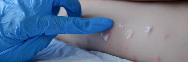 Γιατρός με λαστιχένια γάντια εφαρμογή κρέμας σε κόκκινο εξάνθημα του παιδιού closeup — Φωτογραφία Αρχείου