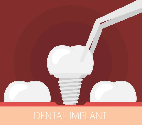 Zubní Implantát Plochý Vektor — Stockový vektor