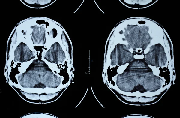 CT i mri czaszki — Zdjęcie stockowe