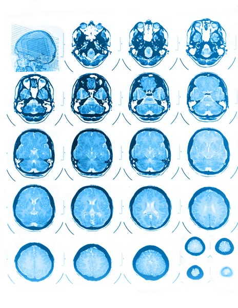 КТ і МРТ черепа — стокове фото