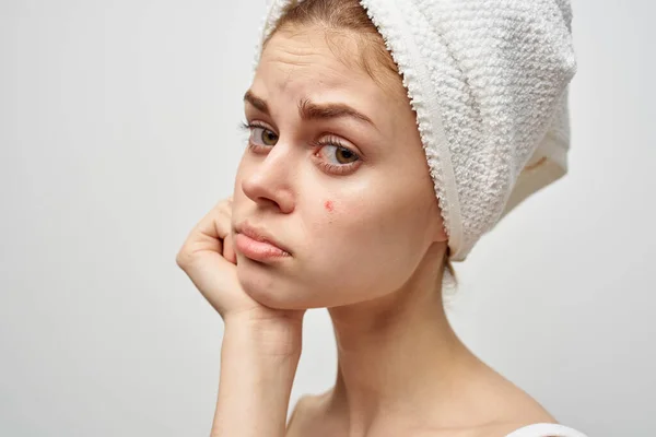 Mujer con gafas muestra un dedo a una espinilla roja en su cara problemas de salud acné — Foto de Stock
