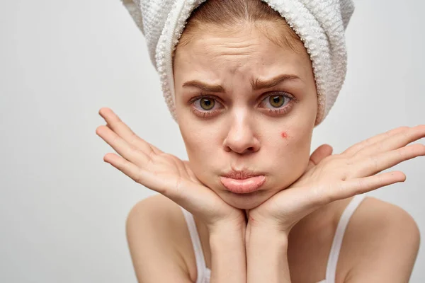 Mujer con una toalla en la cabeza sobre un fondo claro y granos en su cara edad de transición modelo de piel limpia — Foto de Stock
