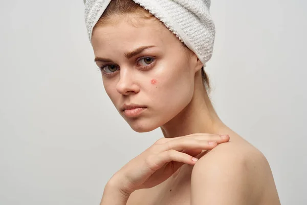 Vrouw met handdoek op hoofd naakte schouders heldere huid acne spa behandelingen — Stockfoto