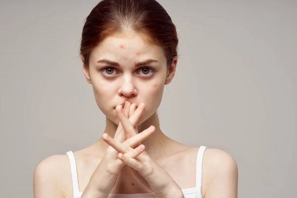 Mujer cara piel problema acné acné retrato recortado ver de cerca — Foto de Stock