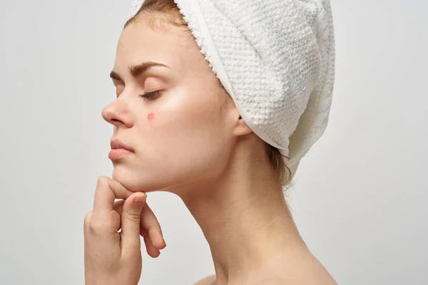 Attractive woman with towel on head naked shoulders pimples on face acne skin care — Stock Photo, Image