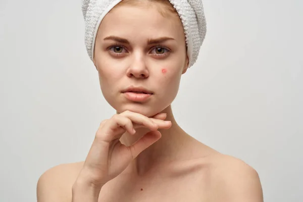 Woman with towel on head naked shoulders clear skin acne spa treatments — Stock Photo, Image