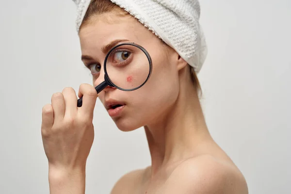 Huidproblemen met acne vrouw met handdoek op het hoofd kleding vergrootglas in de buurt van gezicht — Stockfoto