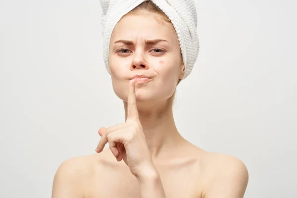 Mujeres en una toalla y con granos en la cara haciendo gestos con las manos limpias acné piel — Foto de Stock