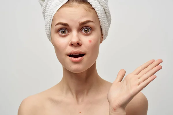 Mujeres en una toalla y con granos en la cara haciendo gestos con las manos limpias acné piel — Foto de Stock