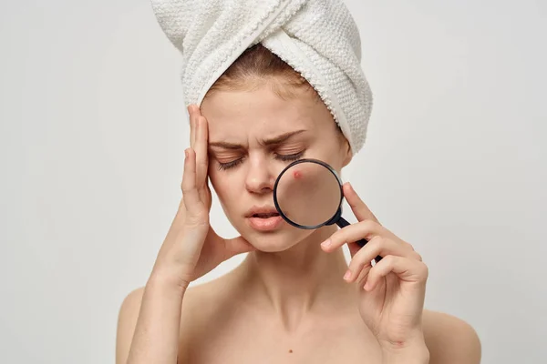 Mujer con acné en la cara sostiene una lupa y toalla de aspecto molesto en la cabeza —  Fotos de Stock
