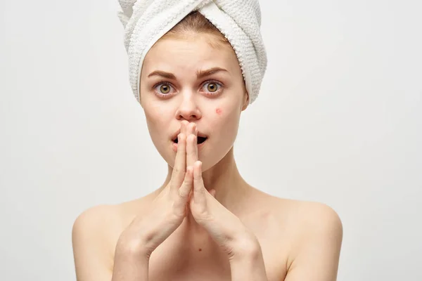 Mulher com toalha na cabeça ombros nus tratamentos de spa acne pele clara — Fotografia de Stock