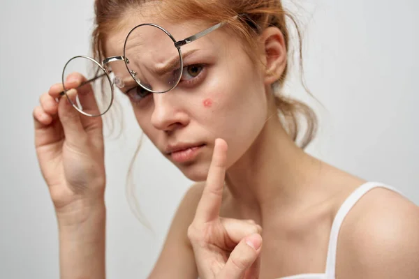 Mujer en gafas muestra un dedo a una espinilla roja en su cara — Foto de Stock