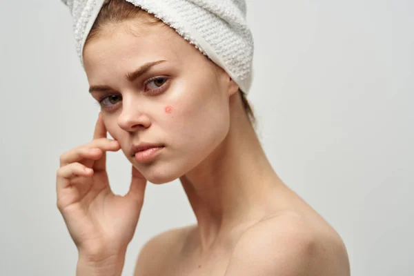 Attraktiv kvinna med handduk på huvudet nakna axlar finnar på ansiktet akne hudvård — Stockfoto